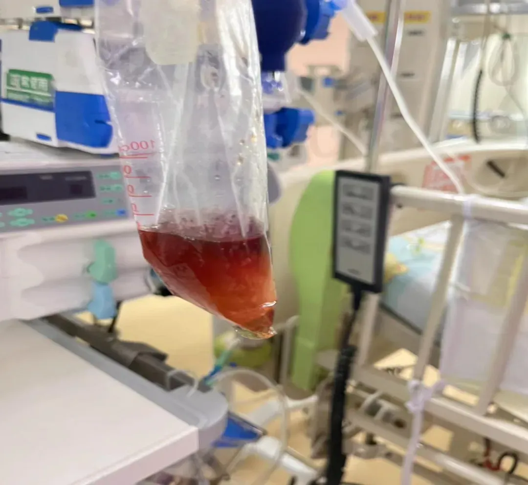 百事达配资 广东5岁男孩吃1包坚果住进ICU！南方人更容易被“盯上” ？如何预防和治疗“蚕豆病”→
